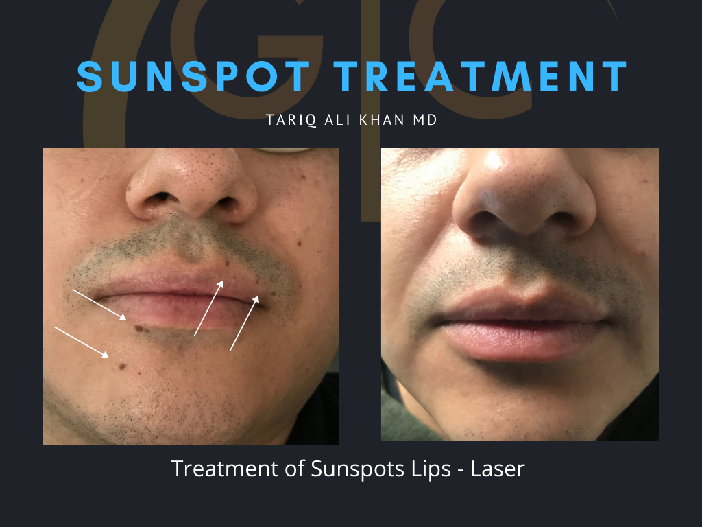 Gentle Care Laser Tustin Before and After picture - Sunspot treatment
